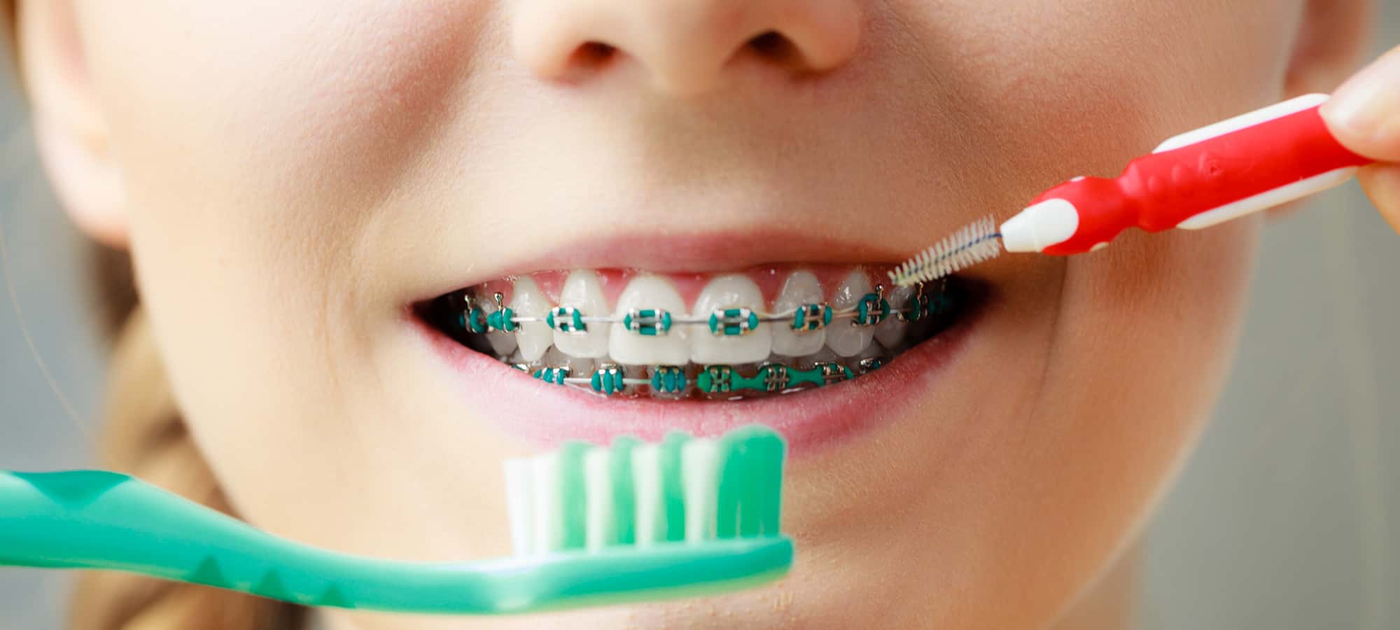 Ensuring Your Child is Taking Care of Their Braces