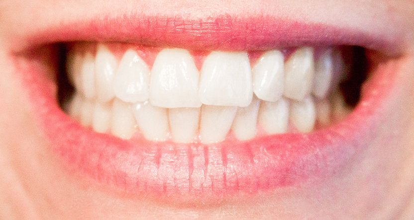 Invisalign Treatment: Teeth Transformations for Teens